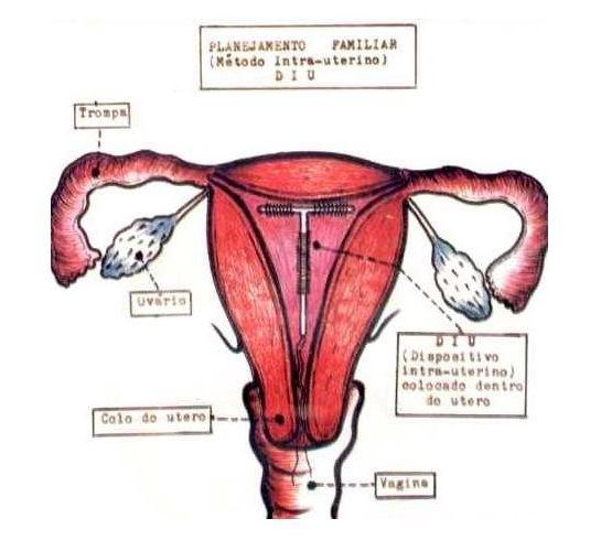 揭秘女性上环全过程