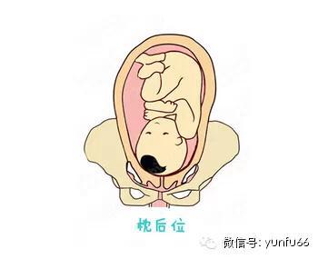 右枕后位胎儿图图片