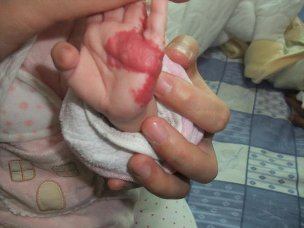 胎毒皮肤图片婴儿图片