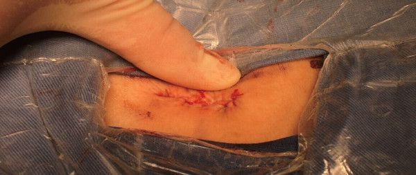 间盘突出患者的方式包括保守治疗,微创介入治疗以及开放性手术治疗