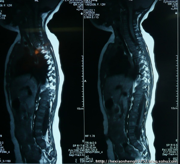 小儿脊髓栓系后背图片