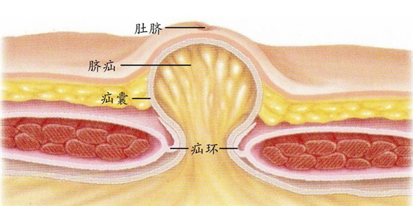 春节长假出游,两招应对疝气(下)