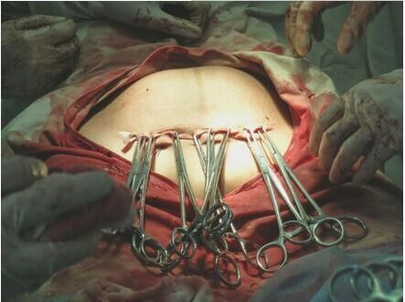 女人生孩子手术图片
