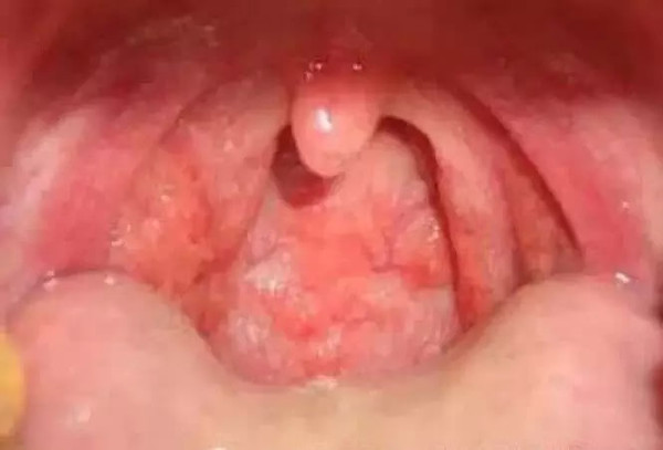 病毒咽喉炎的症状图片图片