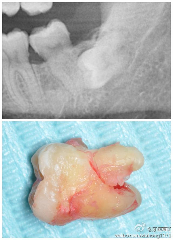骨埋伏阻生智齿图片