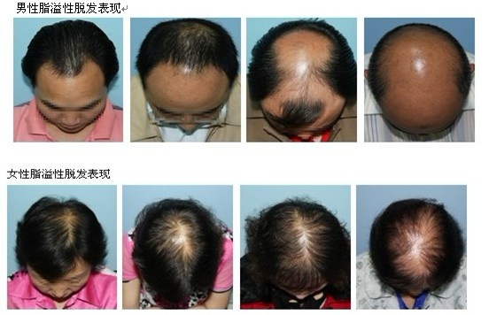 为什么80%的人会得脂溢性脱发?