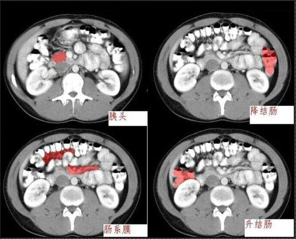 小肠ct分段解剖图图片