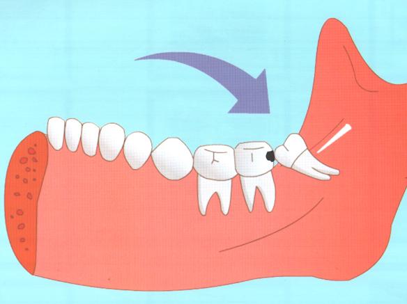 口腔醫生告訴你智齒要不要拔掉