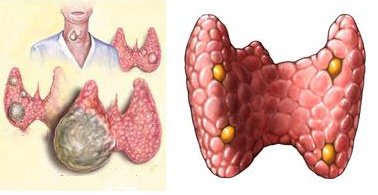 甲状腺癌早期的症状