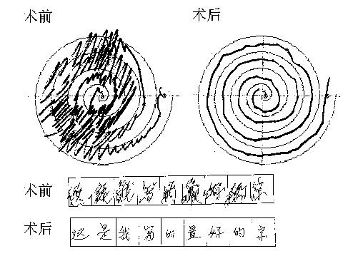 外科 神经外科 帕金森 原发性震颤(essential tremor,et)又称良性