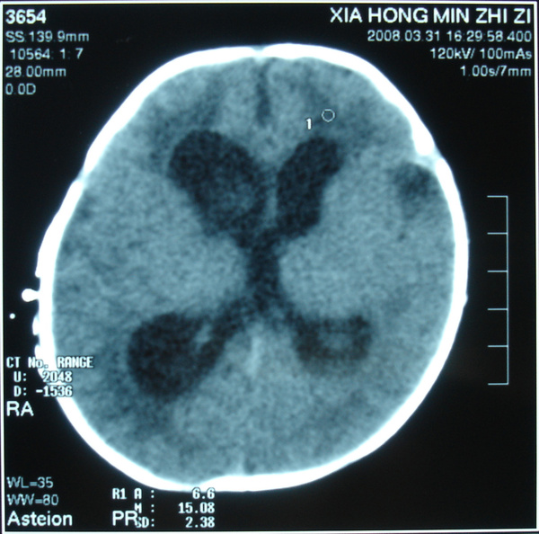 5個月後出現腦積水,頭顱磁共振檢查提示腦室擴張,腦室內未見有出血