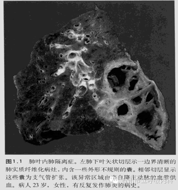 肺隔离症