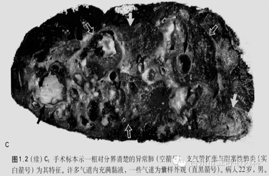 (二,肺叶外肺隔离症:叶外型肺隔离症较叶内型少见男女之比约为4:1