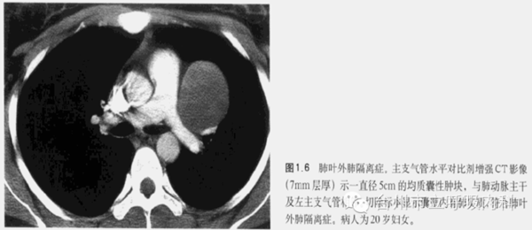 x线胸片:x线胸片 叶外型肺隔离症的胸部x线片常显示均匀,三角形,尖端