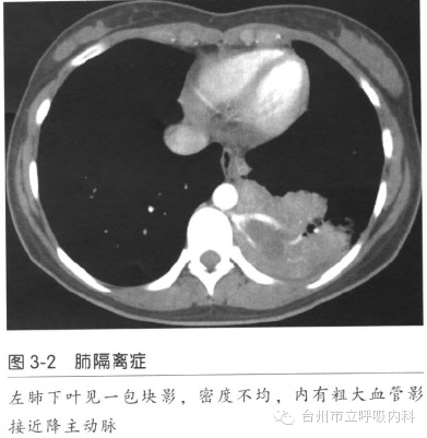 肺隔离症的治疗以手术为主,叶内型可反复继发感染故均应手术治疗,多