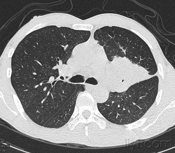 中心型肺癌ct图片图片