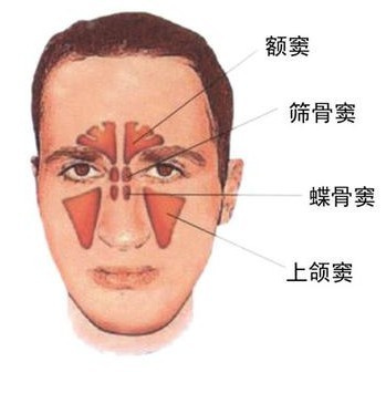 上颌窦炎是什么症状图片