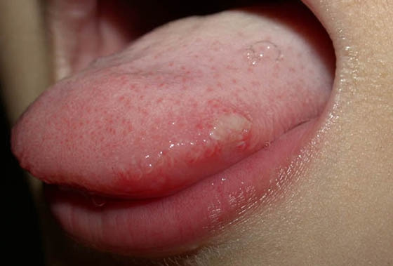 感染hpv舌头图片水泡图片