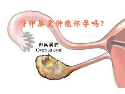 中醫告訴你不花錢的治療方法——卵巢囊腫(良性)