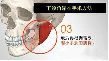 下颌角手术是整形外科中改变人脸型的手段之一,包括磨骨下颌角整形,截