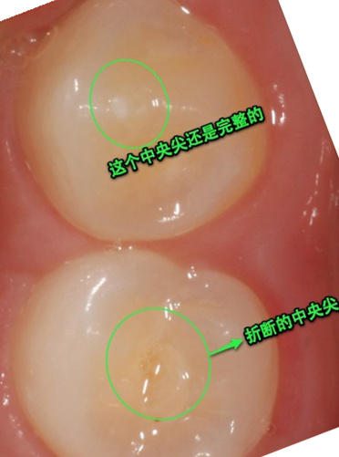 乳牙畸形中央尖图片图片