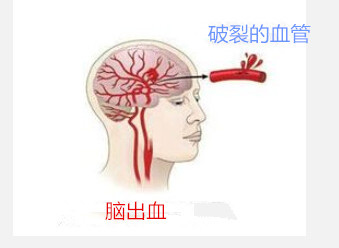 脑出血治疗与预防