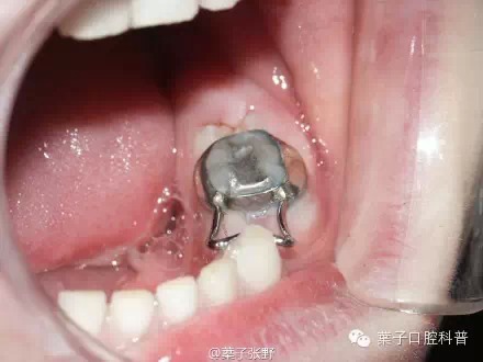 儿童牙齿阻萌器图片