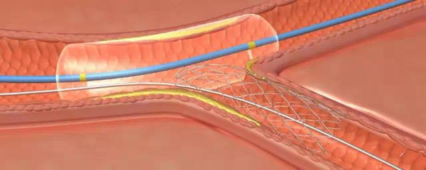 不同之處在於:分支血管裡的支架釋放後,因為處在與主幹血管交界的