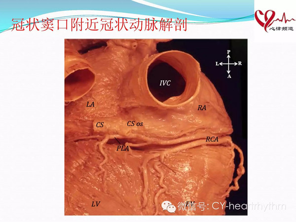 读书报告会冠状窦口附近旁路消融中冠状动脉解剖的价值
