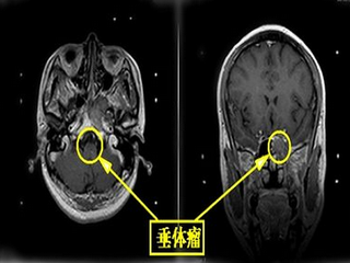 新生兒及小兒神經外科術後管理及急救,面肌痙攣及三叉神經痛顯微血管