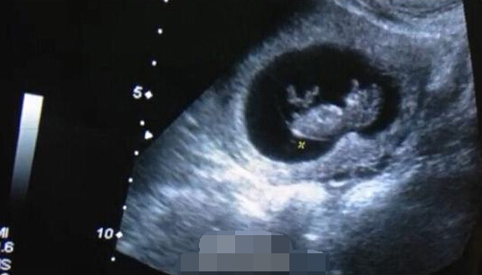 怀孕40天b超图片高清图片
