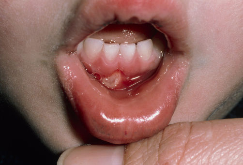 婴儿疱疹图片口腔图片