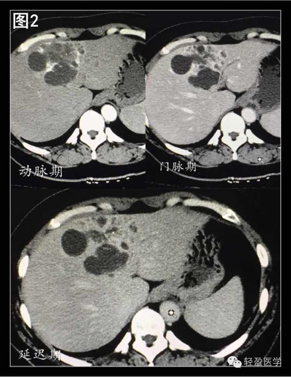 肝海绵状血管瘤ct图片