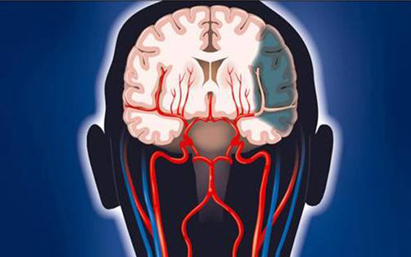 【組圖】腦血栓和腦梗塞本質不同 急救和治療方法各有差異