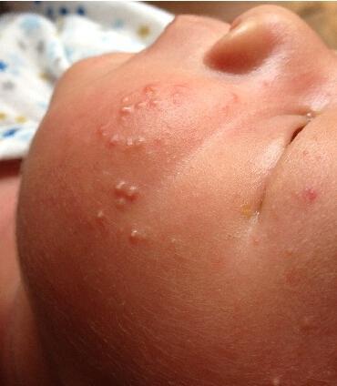 宝宝花粉过敏图片疙瘩图片