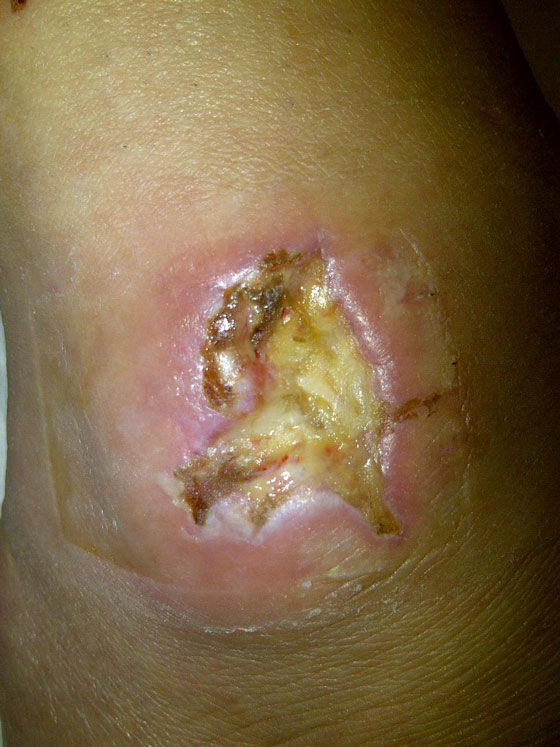 当之后脓疮被除去以后…我的天啊啊啊啊啊啊啊!9.