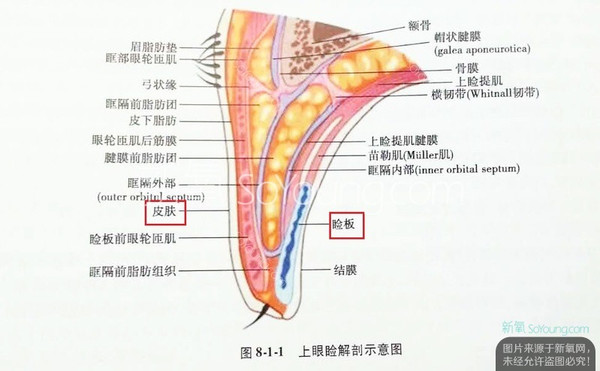 埋线双眼皮的原理图片图片