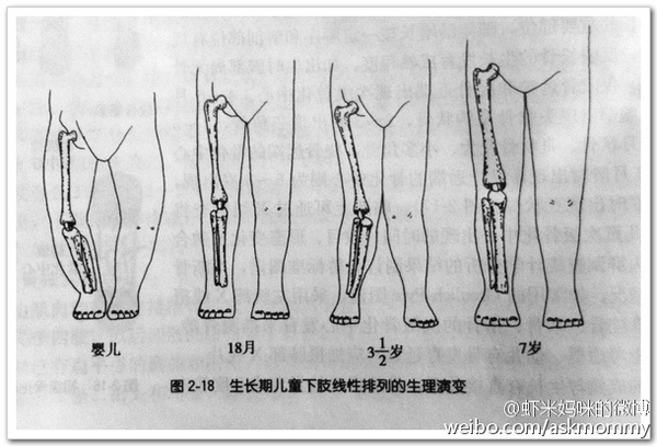 寶寶1歲內大都有輕度的膝內翻——