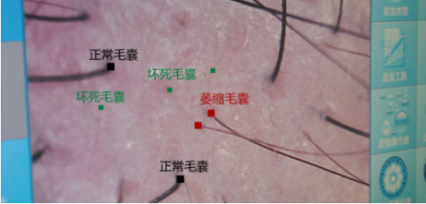 植发手术能让毛囊复活吗?