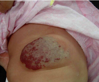 婴儿海绵状血管瘤照片图片