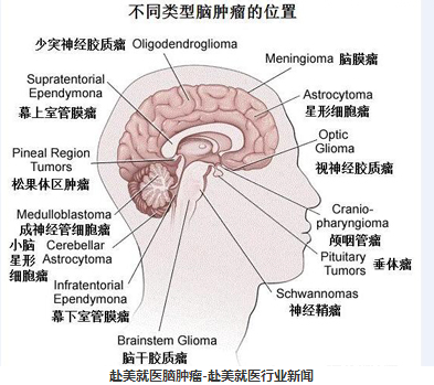 赴美就医:脑肿瘤基本知识