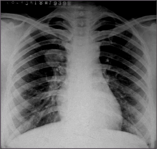 实践技能辅助检查之普通x线影像诊断浸润型肺结核