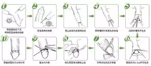 阴茎背神经切断术治疗原发性早泄研究与应用