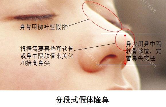 分段式假体隆鼻术后鼻尖不但形状俏丽挺拔,而且能保持自然鼻尖的弹性.