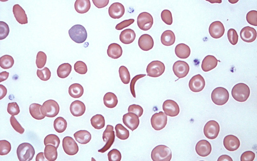 镰刀型细胞贫血症图片图片