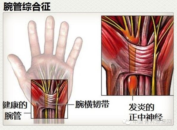 腕管综合征-耳部按摩(组图)腕管综合症误