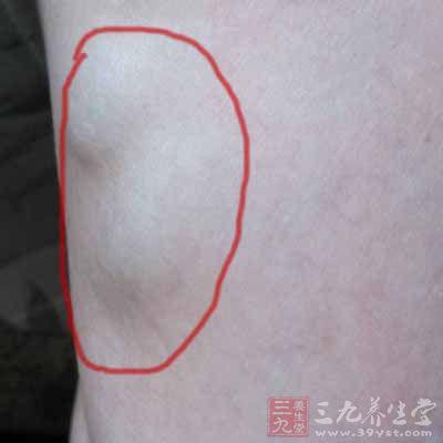 三,后续反应血管癌的出现可能会导致组织病理可见大片吻合,由大小不易