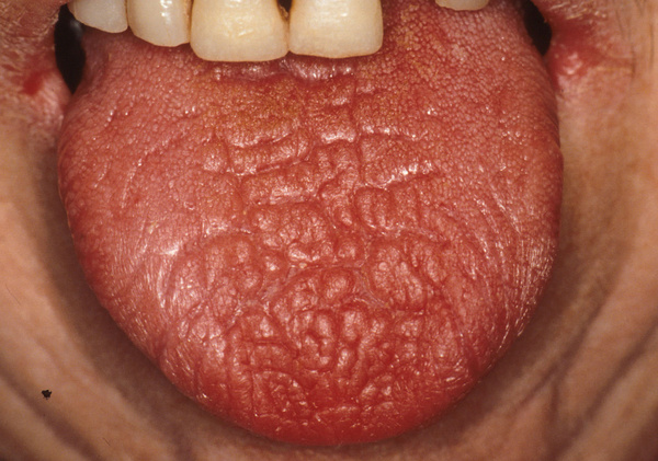 干燥综合症图片舌苔图片
