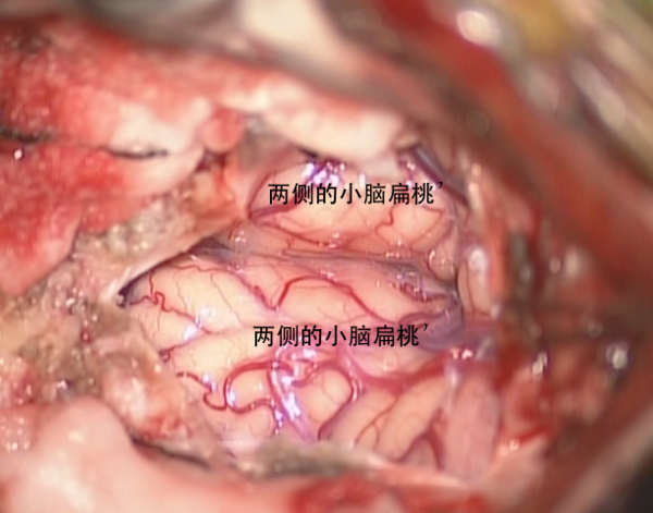 於軟腦膜下部分切除小腦扁桃體後,即可見四腦室出口之脈絡叢,脊髓中央