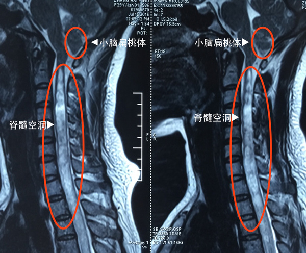 脊髓空洞病图片